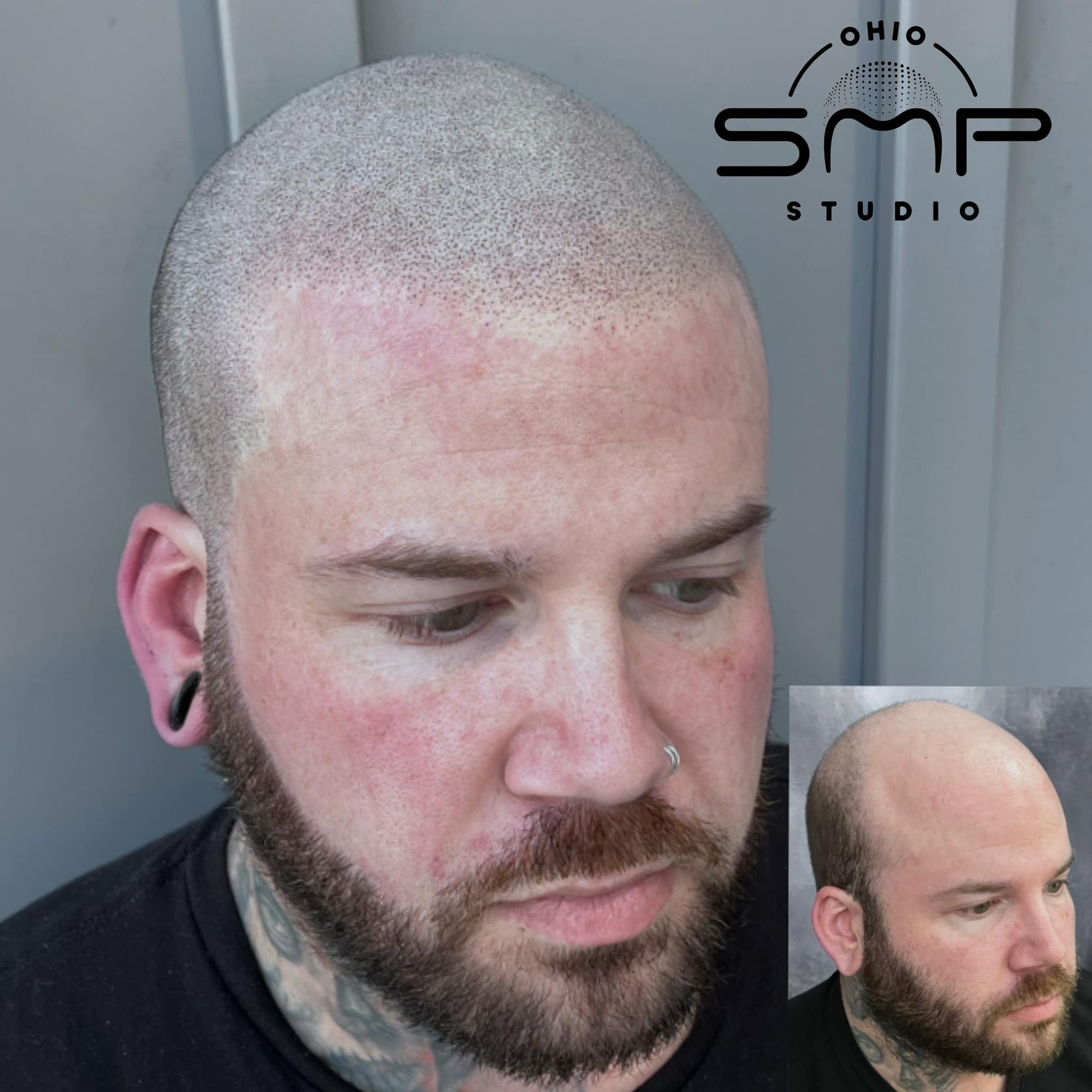 Say Goodbye to Hair Thinning: Ohio SMP Studio in Columbus, OH