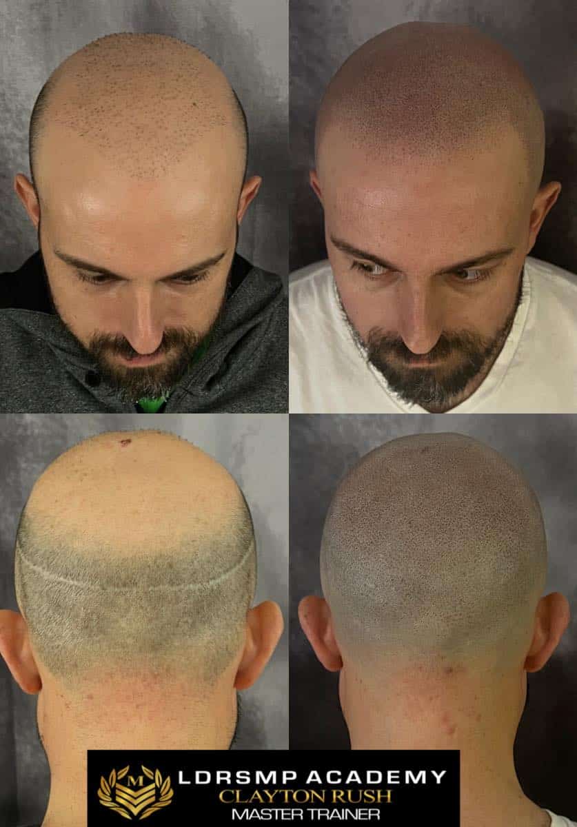 Unveiling the Essence of Hairlines and Hair Loss: Columbus SMP Insight