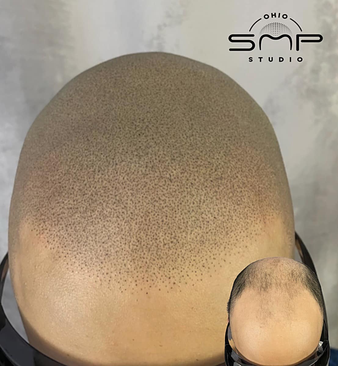 Understanding Hair Loss Types and Solutions | Ohio SMP Studio, Columbus