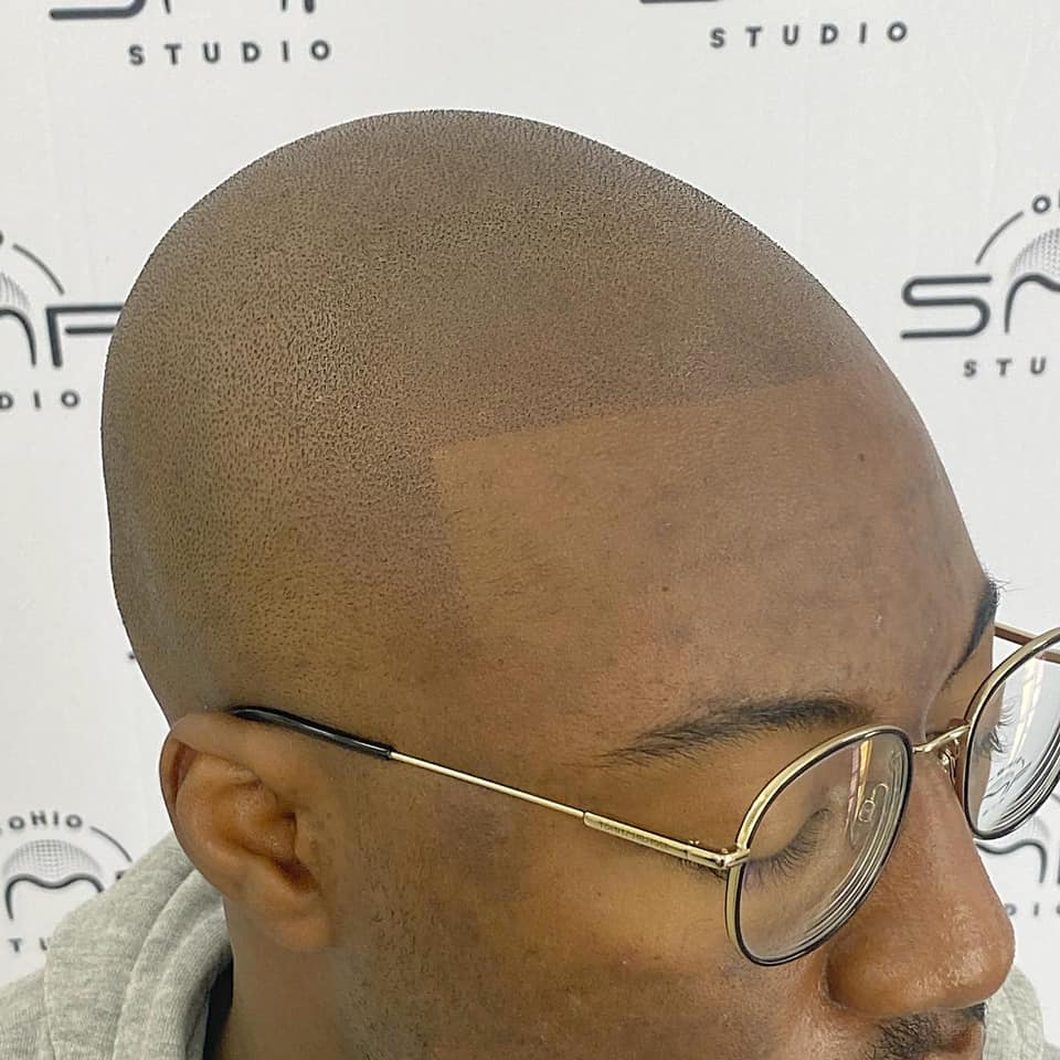 Scalp Micropigmentation: The Ultimate Hair Loss Solution - Learn More ...